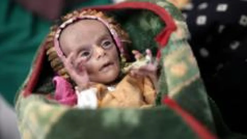 La lucha por sobrevivir de dos gemelos recién nacidos en medio de la crisis de hambre en Yemen